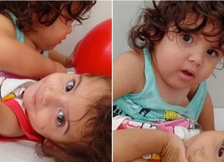 Gêmeas siamesas separadas em Goiânia têm estado grave, mas estável e dentro do esperado