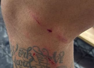 Neymar mostra perna machucada após Santos x Fluminense: ‘Sem intenção também é vermelho’