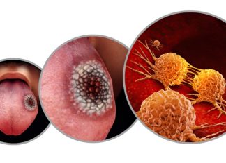 Brasil deve ter 781 mil novos casos de câncer por ano até 2028